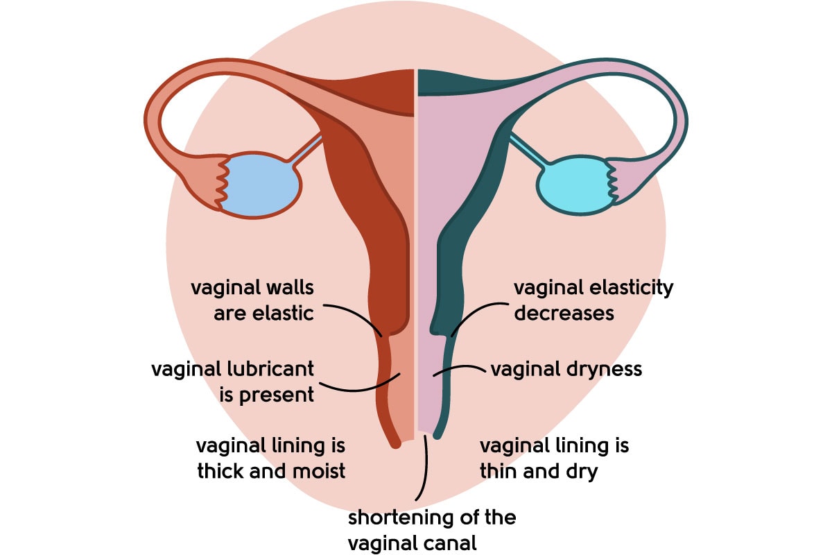 Urinary Incontinence Menopause, Bladder Leakage