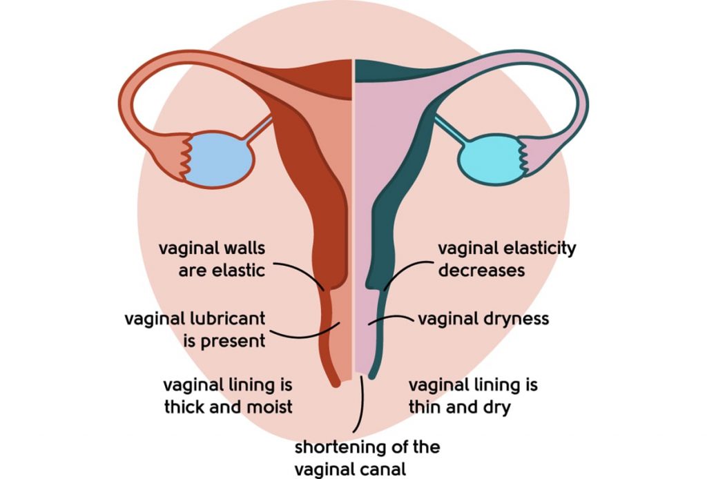 vaginal atrophy discharge