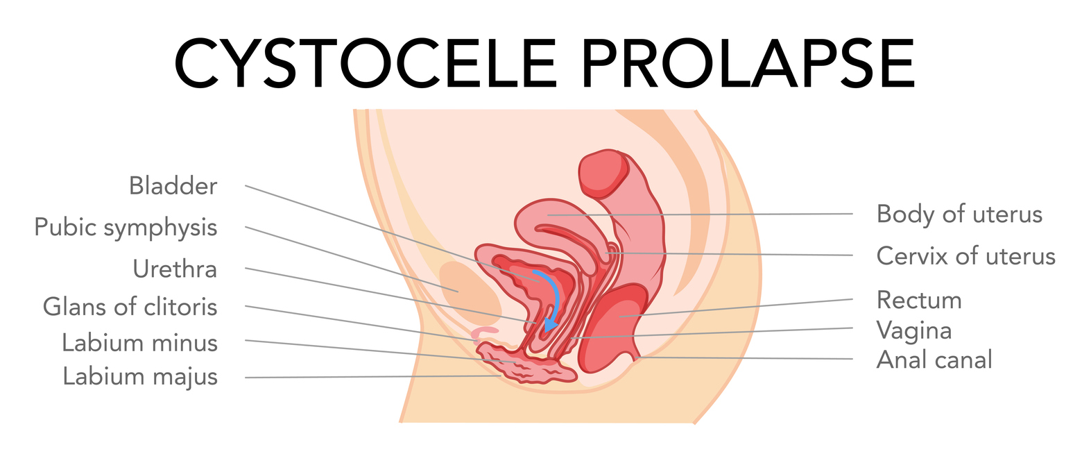 Anterior wall prolapse/Cystocele 