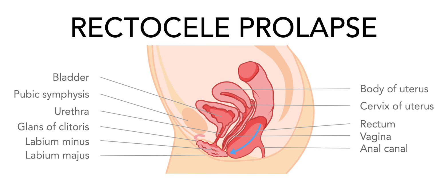 Posterior wall prolapse/rectocele or enterocele 